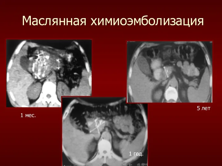 Маслянная химиоэмболизация 1 мес. 1 год. 5 лет