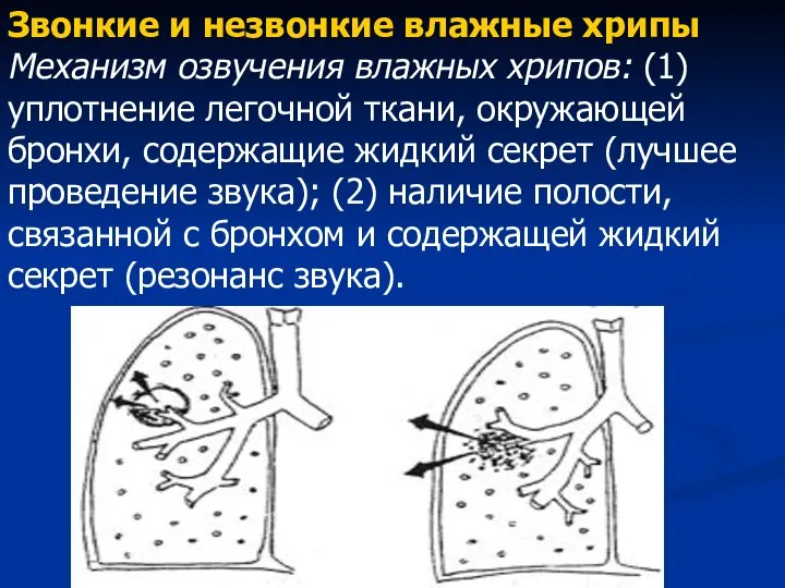 Звонкие и незвонкие влажные хрипы Механизм озвучения влажных хрипов: (1) уплотнение