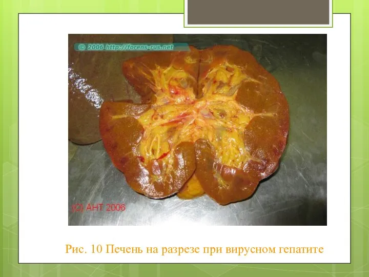 Рис. 10 Печень на разрезе при вирусном гепатите