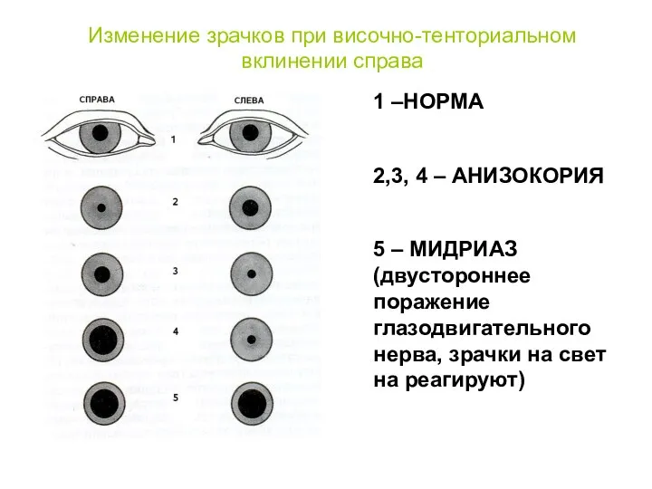 Изменение зрачков при височно-тенториальном вклинении справа 1 –НОРМА 2,3, 4 –