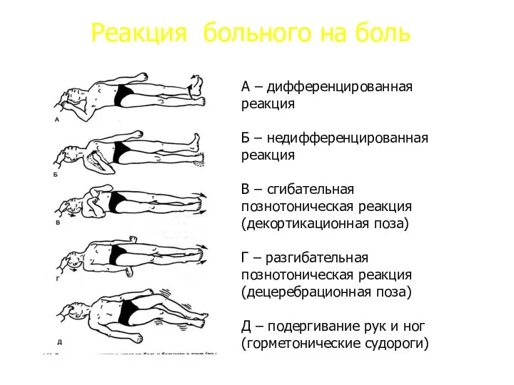 Реакция больного на боль А – дифференцированная реакция Б – недифференцированная