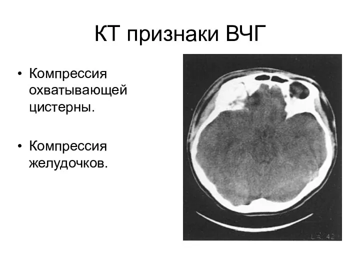 КТ признаки ВЧГ Компрессия охватывающей цистерны. Компрессия желудочков.