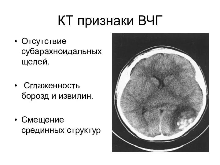 КТ признаки ВЧГ Отсутствие субарахноидальных щелей. Сглаженность борозд и извилин. Смещение срединных структур