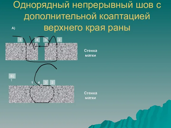 Однорядный непрерывный шов с дополнительной коаптацией верхнего края раны 1 2