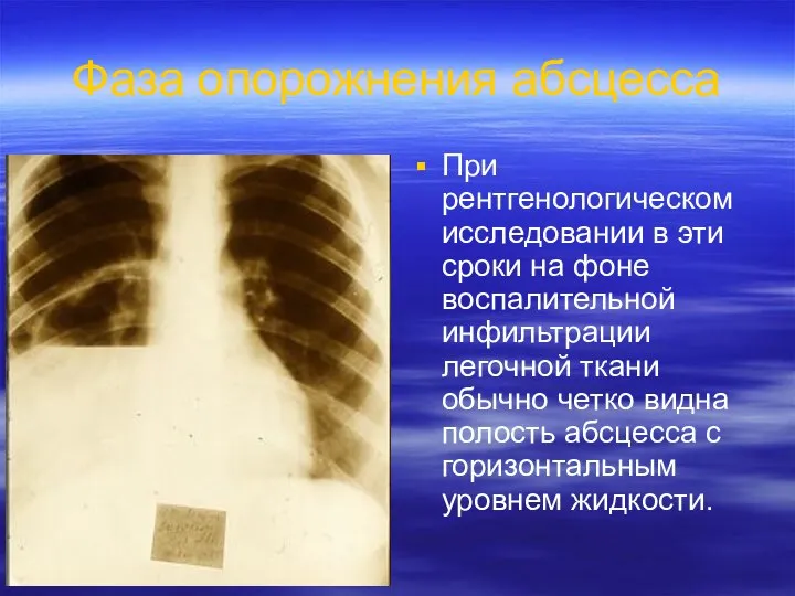 Фаза опорожнения абсцесса При рентгенологическом исследовании в эти сроки на фоне