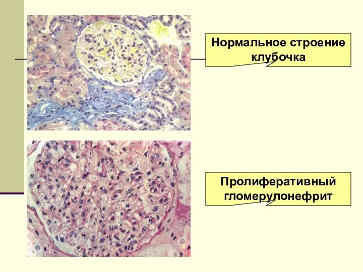 Нормальное строение клубочка Пролиферативный гломерулонефрит