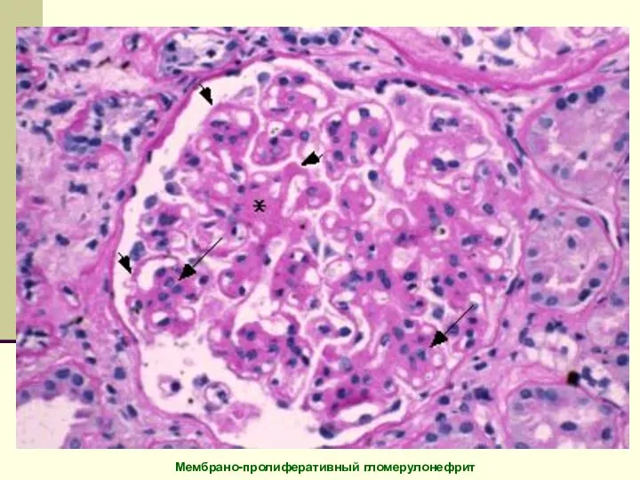 Мембрано-пролиферативный гломерулонефрит