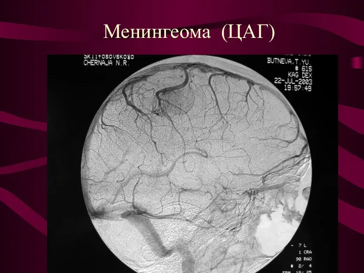 Менингеома (ЦАГ)