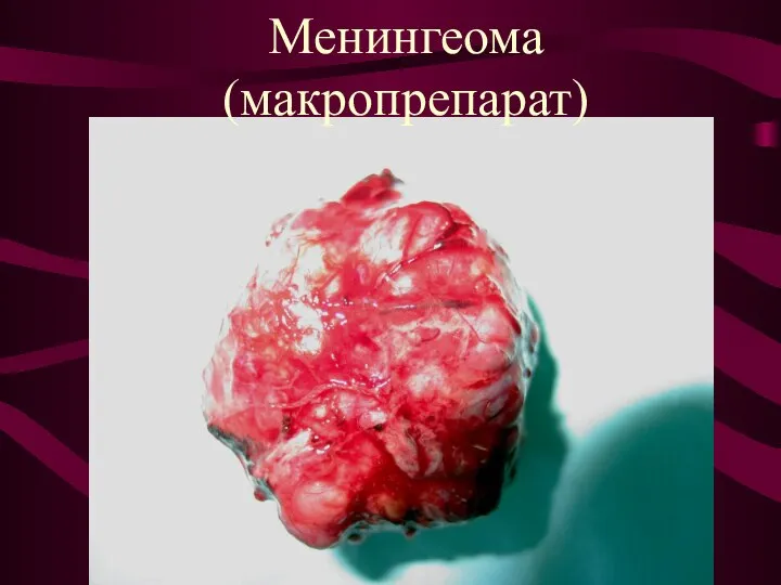 Менингеома (макропрепарат)