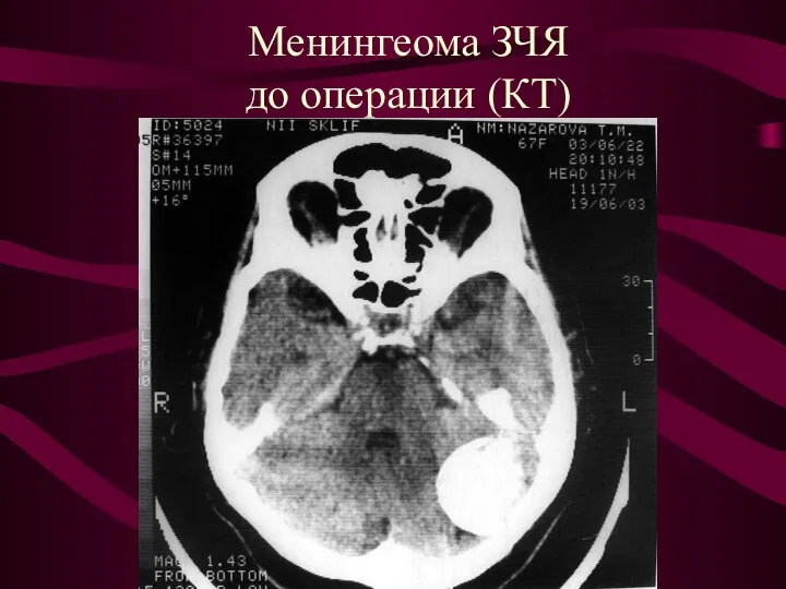 Менингеома ЗЧЯ до операции (КТ)