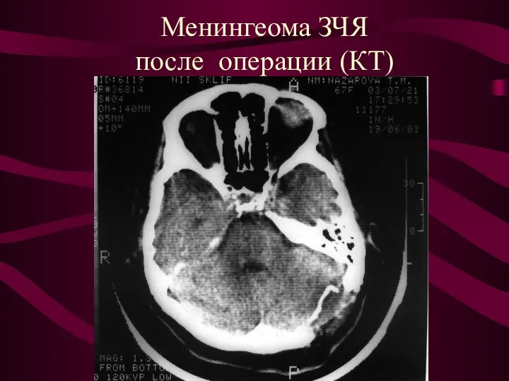 Менингеома ЗЧЯ после операции (КТ)