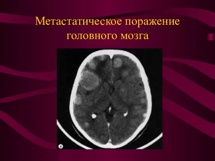 Метастатическое поражение головного мозга