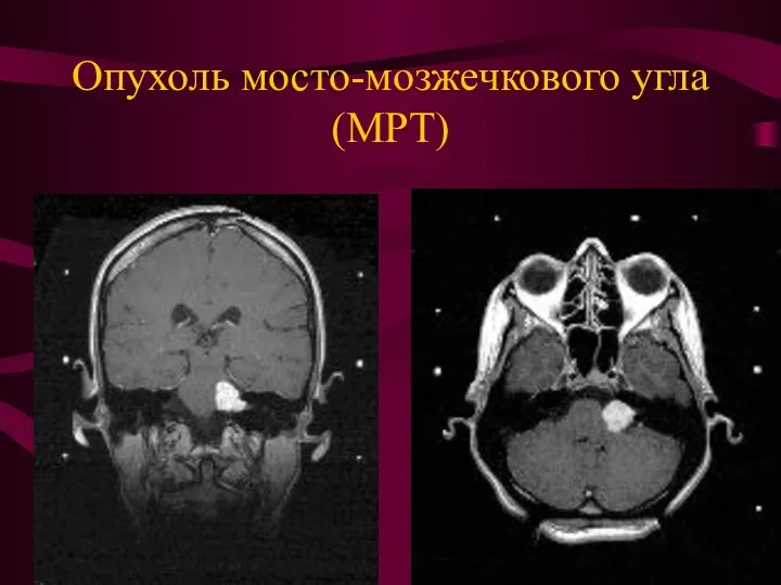 Опухоль мосто-мозжечкового угла (МРТ)