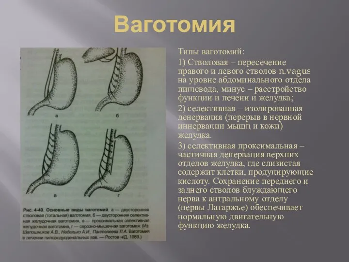 Ваготомия Типы ваготомий: 1) Стволовая – пересечение правого и левого стволов