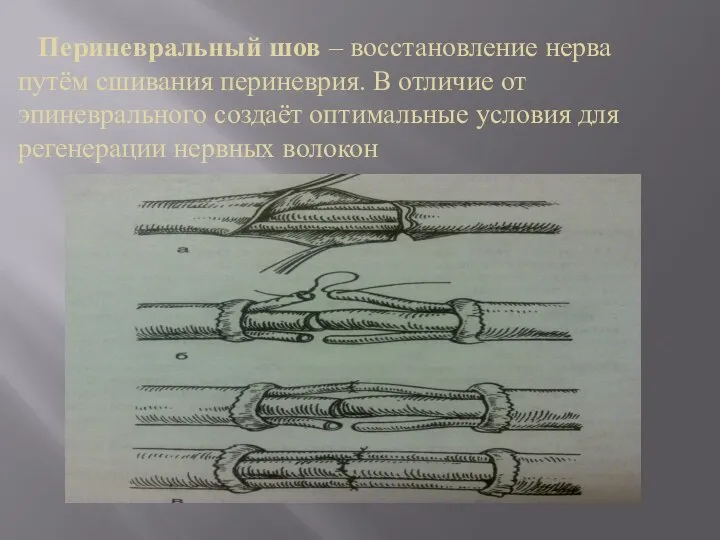 Периневральный шов – восстановление нерва путём сшивания периневрия. В отличие от