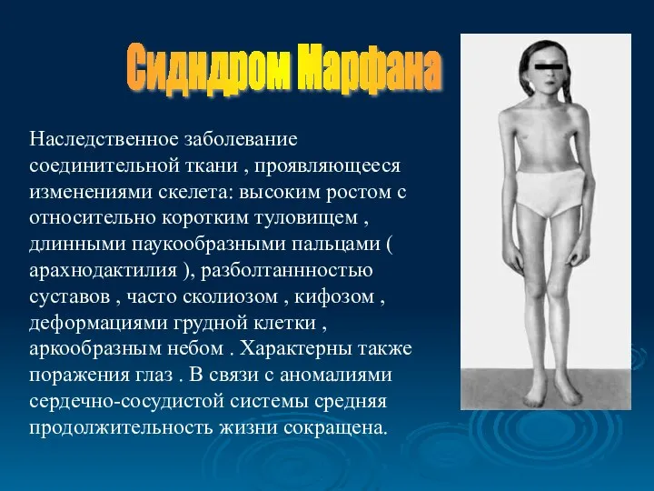 Сидндром Марфана Наследственное заболевание соединительной ткани , проявляющееся изменениями скелета: высоким