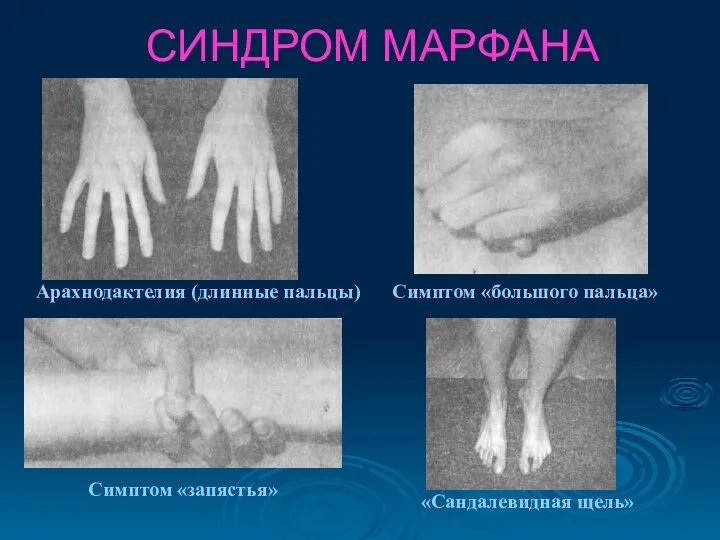 СИНДРОМ МАРФАНА Симптом «большого пальца» Арахнодактелия (длинные пальцы) Симптом «запястья» «Сандалевидная щель»