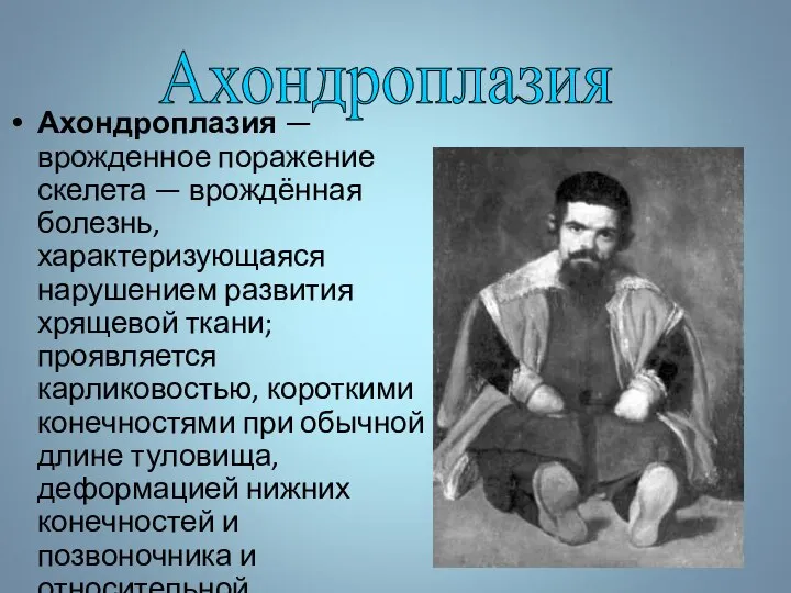 Ахондроплазия — врожденное поражение скелета — врождённая болезнь, характеризующаяся нарушением развития