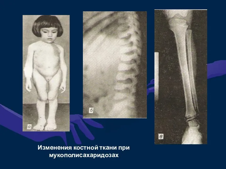 Изменения костной ткани при мукополисахаридозах