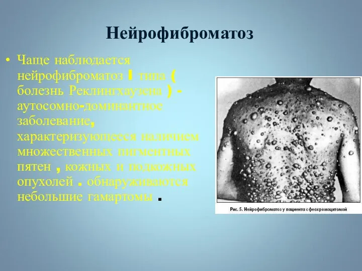 Чаще наблюдается нейрофиброматоз I типа ( болезнь Реклингхаузена ) - аутосомно-доминантное