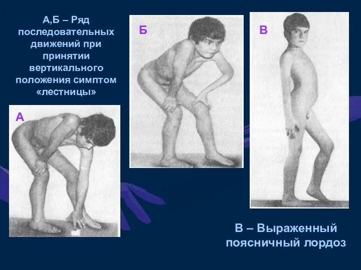 А,Б – Ряд последовательных движений при принятии вертикального положения симптом «лестницы»