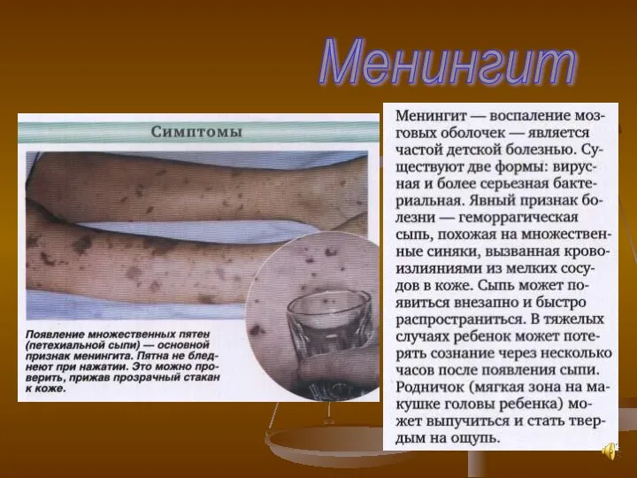 Менингит