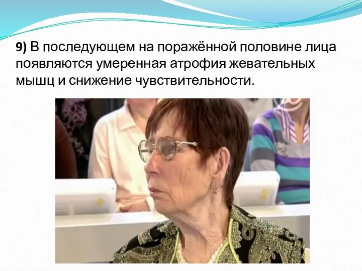 9) В последующем на поражённой половине лица появляются умеренная атрофия жевательных мышц и снижение чувствительности.