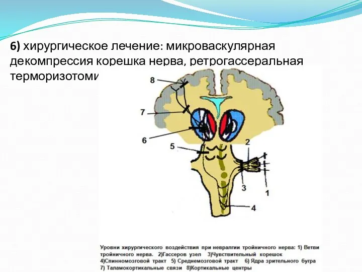 6) хирургическое лечение: микроваскулярная декомпрессия корешка нерва, ретрогассеральная терморизотомия, нервэкзерез.