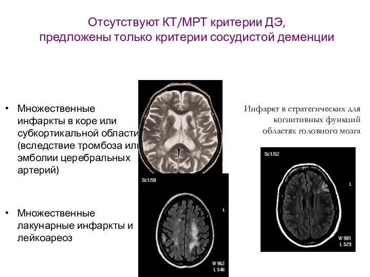 Отсутствуют КТ/МРТ критерии ДЭ, предложены только критерии сосудистой деменции Множественные инфаркты