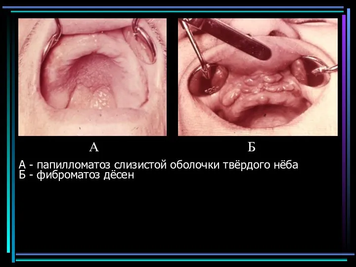А - папилломатоз слизистой оболочки твёрдого нёба Б - фиброматоз дёсен А Б