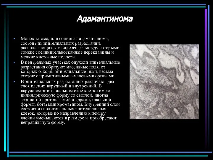 Адамантинома Монокистома, или солидная адамантинома, состоит из эпителиальных разрастаний, располагающихся в