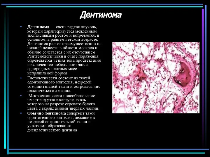 Дентинома Дентинома — очень редкая опухоль, который характеризуется медленным экспансивным ростом