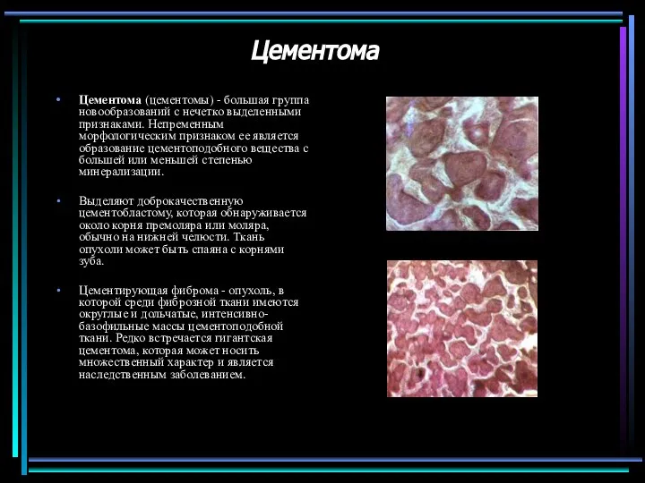 Цементома Цементома (цементомы) - большая группа новообразований с нечетко выделенными признаками.