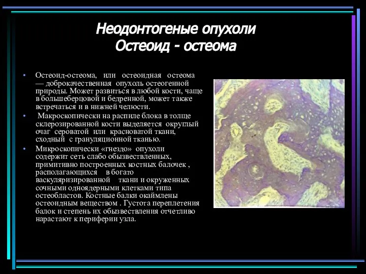 Неодонтогеные опухоли Остеоид - остеома Остеоид-остеома, или остеоидная остеома — доброкачественная