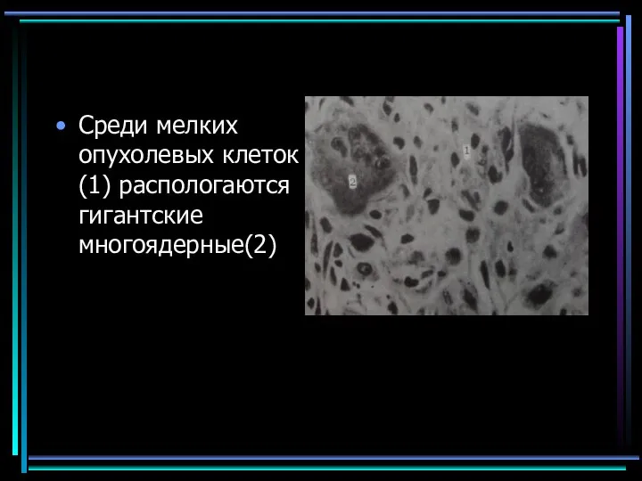 Среди мелких опухолевых клеток(1) распологаются гигантские многоядерные(2)