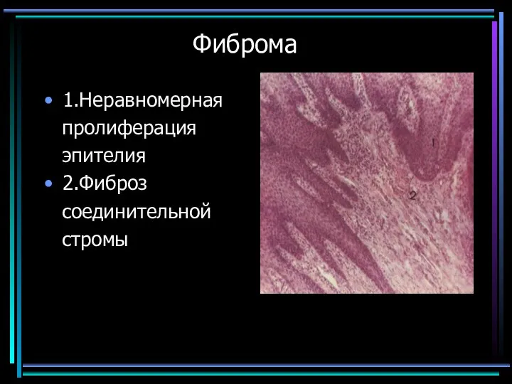 Фиброма 1.Неравномерная пролиферация эпителия 2.Фиброз соединительной стромы