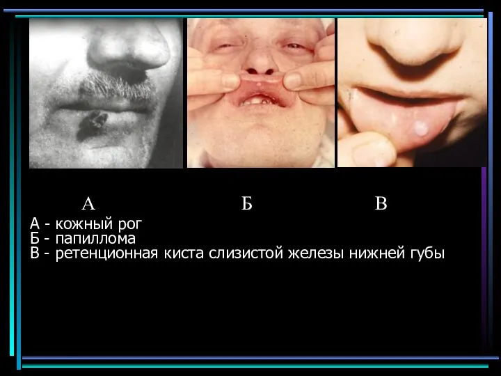 А - кожный рог Б - папиллома В - ретенционная киста