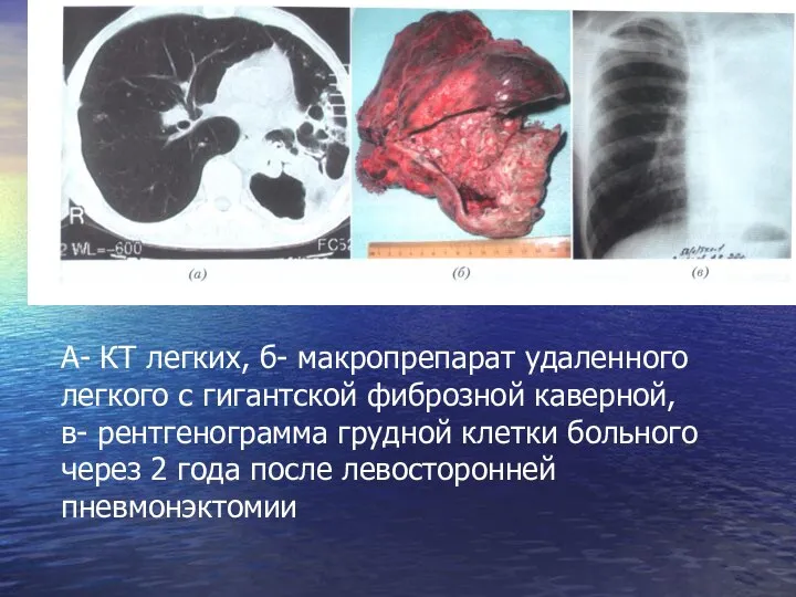 А- КТ легких, б- макропрепарат удаленного легкого с гигантской фиброзной каверной,