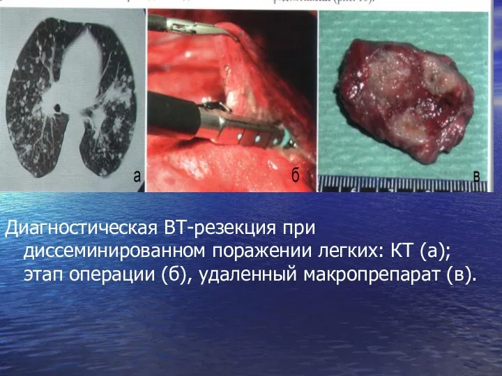 Диагностическая ВТ-резекция при диссеминированном поражении легких: КТ (а); этап операции (б), удаленный макропрепарат (в).