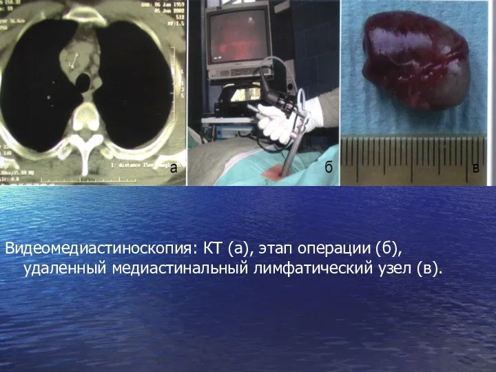 Видеомедиастиноскопия: КТ (а), этап операции (б), удаленный медиастинальный лимфатический узел (в).