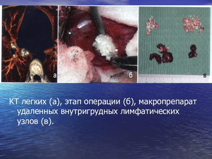 КТ легких (а), этап операции (б), макропрепарат удаленных внутригрудных лимфатических узлов (в).