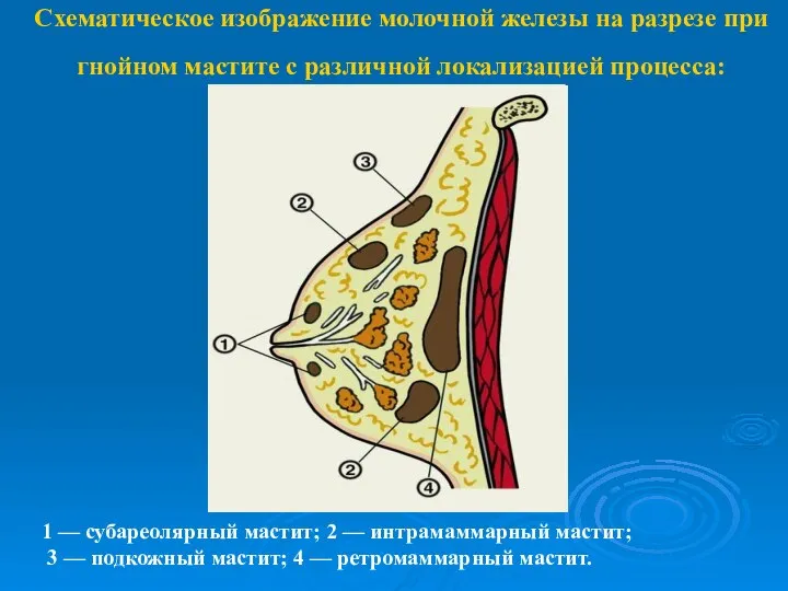 Схематическое изображение молочной железы на разрезе при гнойном мастите с различной