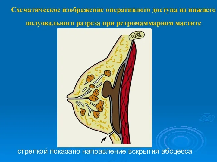 Схематическое изображение оперативного доступа из нижнего полуовального разреза при ретромаммарном мастите стрелкой показано направление вскрытия абсцесса