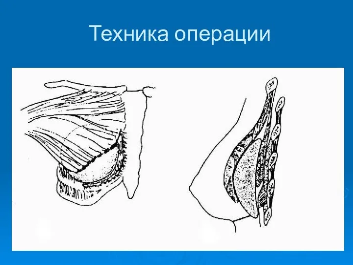 Техника операции