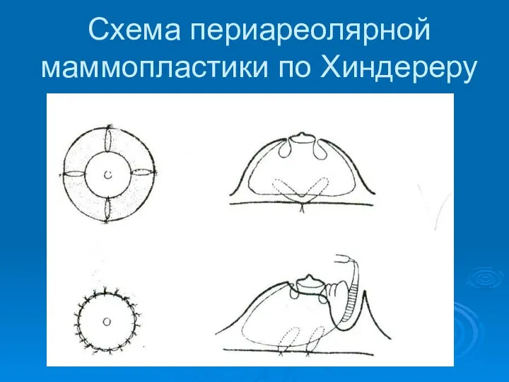 Схема периареолярной маммопластики по Хиндереру