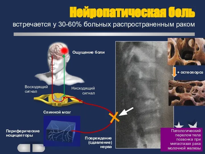 Восходящий сигнал Нисходящий сигнал Ощущение боли Спинной мозг Периферические ноцицепторы Патологический