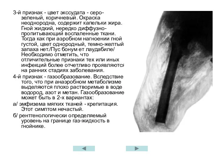 3-й признак - цвет экссудата - серо-зеленый, коричневый. Окраска неоднородна, содержит