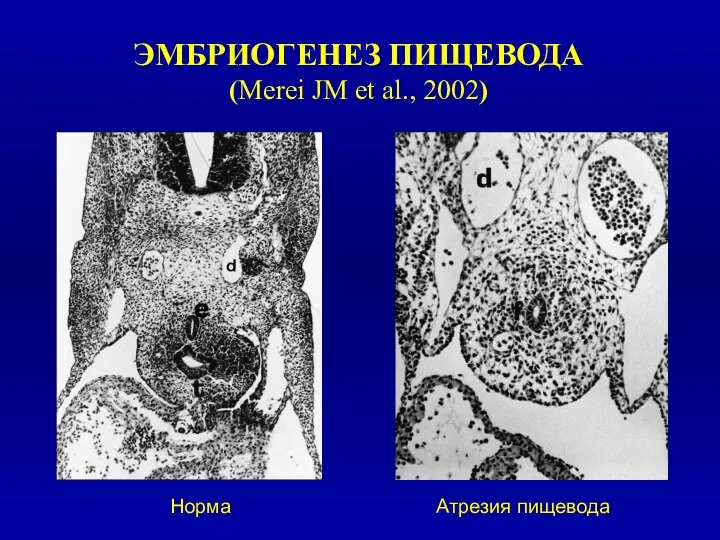 ЭМБРИОГЕНЕЗ ПИЩЕВОДА (Merei JM et al., 2002) Норма Атрезия пищевода