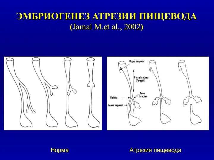 ЭМБРИОГЕНЕЗ АТРЕЗИИ ПИЩЕВОДА (Jamal M.et al., 2002) Норма Атрезия пищевода