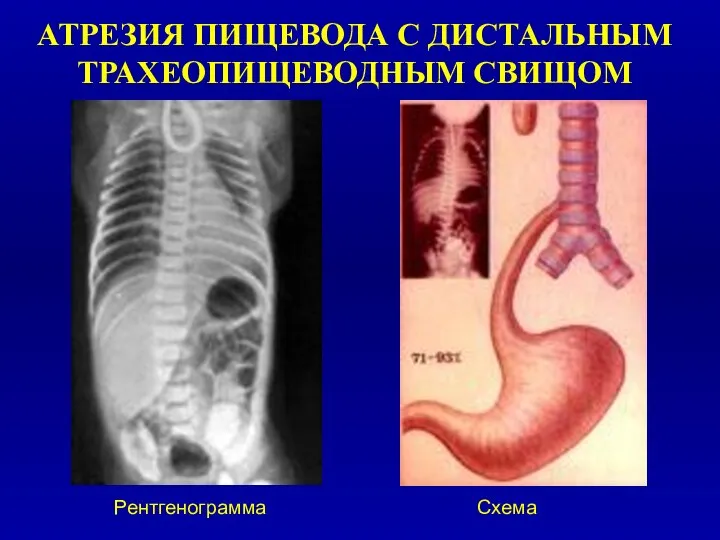 АТРЕЗИЯ ПИЩЕВОДА С ДИСТАЛЬНЫМ ТРАХЕОПИЩЕВОДНЫМ СВИЩОМ Рентгенограмма Схема